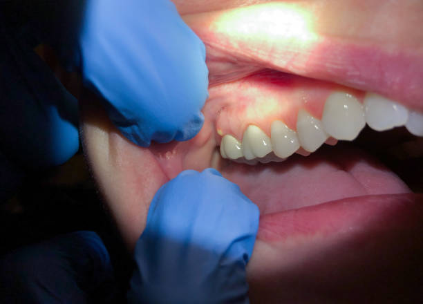 Best Emergency Wisdom Teeth Removal in Bridgeport, OH