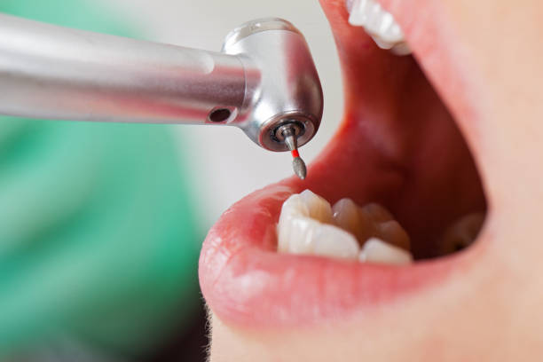 Best Emergency Wisdom Teeth Removal in Bridgeport, OH